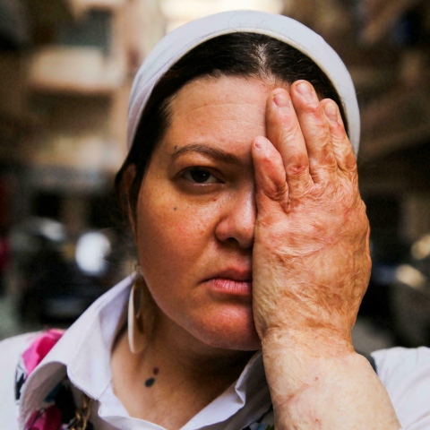 صور: من قلب أم الدنيا: مبادرة "احتواء" لتغيير نظرة المجتمع لضحايا الحروق
